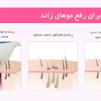 لیزر موهای زائد فقط بانوان