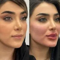 انجام تمام خدمات فیلر|خدمات آرایشگری و زیبایی|شهرکرد, |دیوار