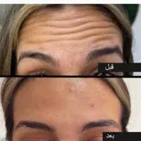 تزریق بوتاکس اصلی، ژل لب، خط خنده، زاویه فک وچانه|خدمات آرایشگری و زیبایی|ورامین, ورامین|دیوار