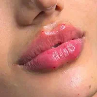 تزریق ژل و بوتاکس