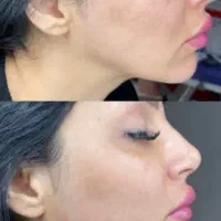 خدمات ژل و بوتاکس هر سی سی ژل ۴۸۰|خدمات آرایشگری و زیبایی|اهواز, حصیرآباد|دیوار