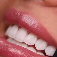 دندانپزشکی.لمینت.ایمپلنت.