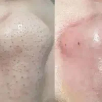 فشیال و پاکسازی صورت|خدمات آرایشگری و زیبایی|اردبیل, |دیوار