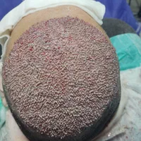 کاشت مو فول تراکم با حداقل ۲۰ هزار تار مو کاشت|خدمات آرایشگری و زیبایی|قزوین, |دیوار