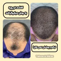 کاشت مو و ابروی طبیعی|خدمات آرایشگری و زیبایی|تهران, سعادت‌آباد|دیوار