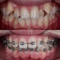 جشنواره اقساطی ارتودنسی و ونیر کامپوزیت