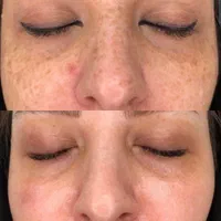 کلینیک پوست رفع لک باتکنیک فلت اولین بار در یزد|خدمات آرایشگری و زیبایی|یزد, |دیوار