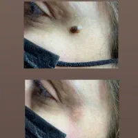 برداشت خال با خلال دندان|آرایشی، بهداشتی، درمانی|تربتحیدریه, پارک پرستار|دیوار