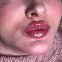 تخفیف ژل لب ۸۰۰وکانتورینگ ۵/۰۰۰،فیلربادی،بوتاکس