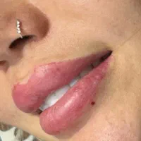 ژل و بوتاکس اقساط+فیلر بادی