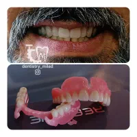 دندان سازی،مصنوعی،دندان متحرک،دندانسازی