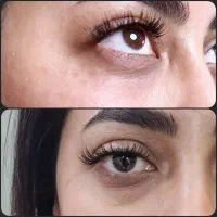 آفر باورنکردنی برطرف کردن گودی و تیرگی زیر چشم