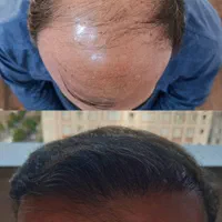 کاشت موی طبیعی سبک شیرازی|خدمات آرایشگری و زیبایی|تهران, زعفرانیه|دیوار