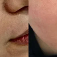 جشنواره‌ی‌لیزرCO2فرکشنال(رفع‌‌خال،کک‌ومک،جای‌جوش‌)