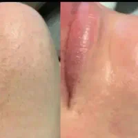 اموزش،فشیال تخصصی..مزوندلینگ پلکسرفقط 3 میلیون