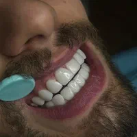 کامپوزیت. لمینت .عصب کشی .مروارید|خدمات آرایشگری و زیبایی|مشکین‌دشت, |دیوار