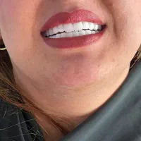 لبخندی زیبا با بهترین کیفیت و متریال با اقساط ویژه