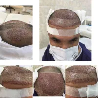 کاشت مو در بندرعباس، هماهنگی در قشم
