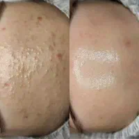 فیشال و پاکسازی تخصصی پوست در اهواز