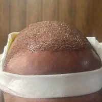 کاشت مو و کاشت ابرو اقساطی و تضمینی|خدمات آرایشگری و زیبایی|ارومیه, |دیوار