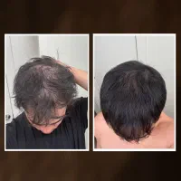 موی پرپشت ، به ژنتیک ربطی نداره