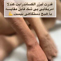 لیزر موهای زائد الکساندرایت کندلا /بانوان و آقایان|خدمات آرایشگری و زیبایی|اصفهان, سیچان|دیوار