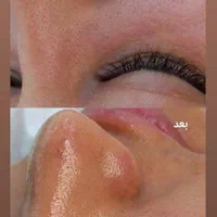 تخفیف پاکسازی و فیشیال