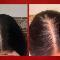 پرپشتی مو دیگه آرزو نیست