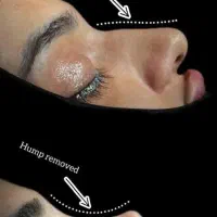 عمل بینی|خدمات آرایشگری و زیبایی|کرج, عظیمیه|دیوار