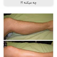 لیزر فول بادی به مدت یک هفته ۳۸۰