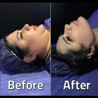 ساکشن غبغب با پال دیجیتالی و اندولیفت پوست اضافه|خدمات آرایشگری و زیبایی|مشهد, سناباد|دیوار