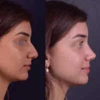 عمل بینی فقط 25م باروش جدید/بدون درد+مشاوره رایگان|خدمات آرایشگری و زیبایی|شیراز, فرهنگ شهر|دیوار