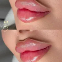 تزریق ژل بوتاکس مزو