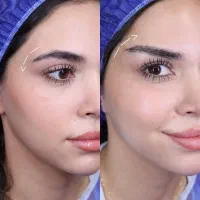 جراحی زیبایی با تسهیلات درمانی/ بلفارو/لیفت صورت