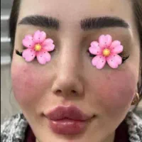 ژل لبMانزیم چربی سوز غبغب و فیلر زیر چشم خط خنده