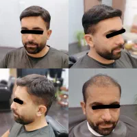 پروتز مو کاشت مو بدون درد و نقاهت وخونریزی 2 ساعته