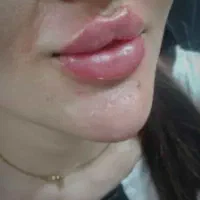 جشنواره فیلرو بوتاکس با قیمت باور نکردنی در مطب|خدمات آرایشگری و زیبایی|کرج, گوهردشت|دیوار