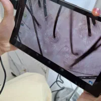 درمان قطعی موخوره و ریزش مو رایگان شد.|خدمات آرایشگری و زیبایی|رشت, کوی بیانی|دیوار