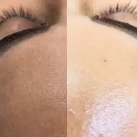 اصلاح صورت درما|خدمات آرایشگری و زیبایی|زابل, |دیوار