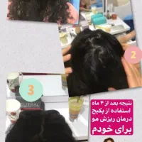 درمان ریزش مو و رویش مجدد مو