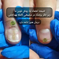 درمان ناخن فرورفته درگوشت بدون جراحی در کلینیک|خدمات آرایشگری و زیبایی|ورامین, خیر آباد|دیوار