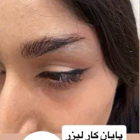 پاک کردن تتو با لیزر با قیمت فوق العاده|خدمات آرایشگری و زیبایی|کرمانشاه, |دیوار