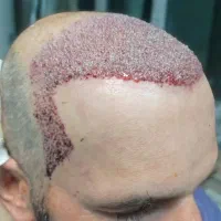 کاشت مو طبیعی