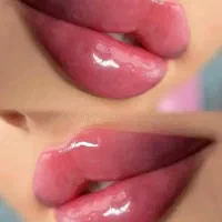 تزریق ژل فیلربوتاکس تخفیفات50درصدی برای زیباجویان|خدمات آرایشگری و زیبایی|زاهدان, |دیوار