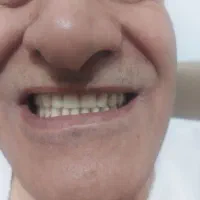 دندان متحرک مصنوعی بقیمت سنندج۶/۵ زرین آباد ایجرود|فعالیت داوطلبانه تحقیقاتی|زنجان, |دیوار