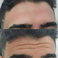 آف ویژه ی ۴۰٪خدمات زیبایی ژل وبوتاکس(آدرس ایذه)