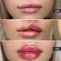 مدل تزریق لب روسی و کانتور صورت و تزریق بیکینی|خدمات آرایشگری و زیبایی|تهران, زعفرانیه|دیوار