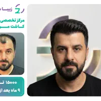 کاشت یک روزه مو با حداکثر تراکم روش f u e+ اختصاصی