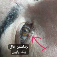 برداستن خال ، ختنه، زگیل،میخچه، جراحی سرپایی درمطب|خدمات آرایشگری و زیبایی|تویسرکان, |دیوار