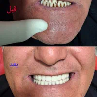 ساخت دندان مصنوعی اقتصادی وبا کیفیت|خدمات آرایشگری و زیبایی|ری, دیلمان|دیوار